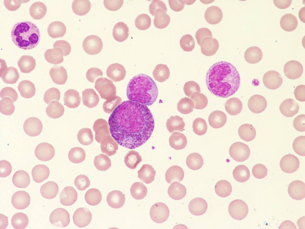 leukaemia-980x735-1.jpg