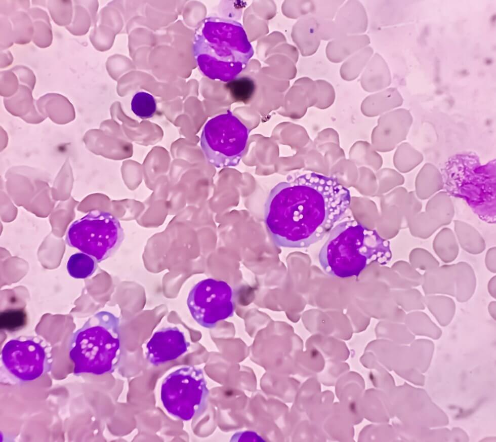 acute_lymphoblastic_leukaemia-980x873-1.jpg