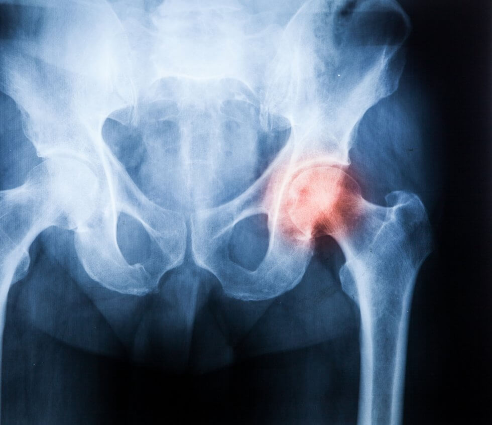 hip_pain-980x846-1.jpg
