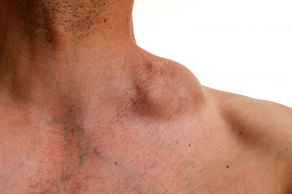 lymphoma_lymph_node-980x653-1.jpg