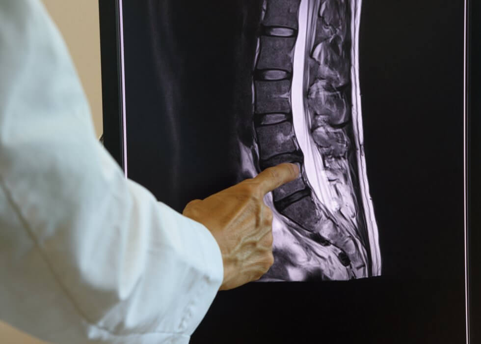 spinal_injury-980x700-1.jpg