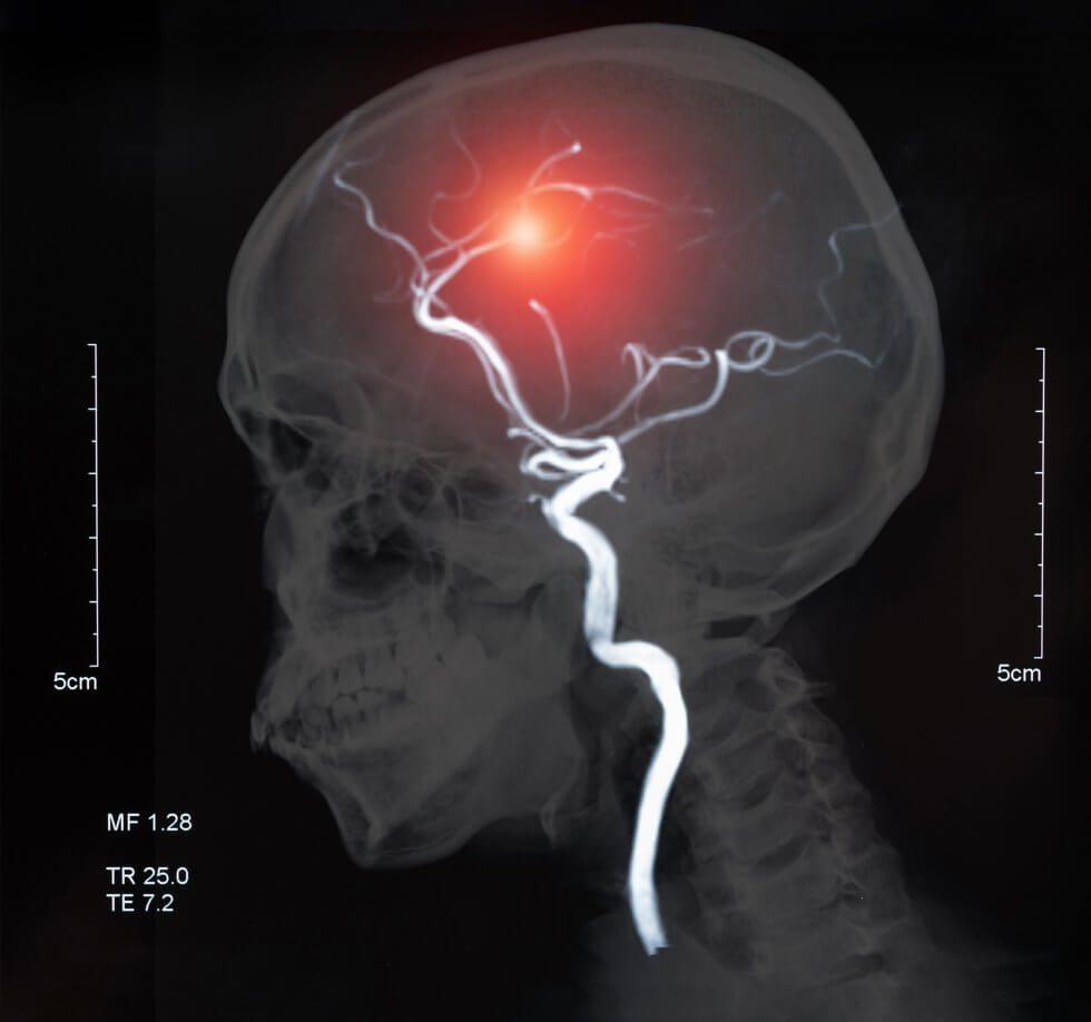 stroke_in_the_brain-980x918-1.jpg